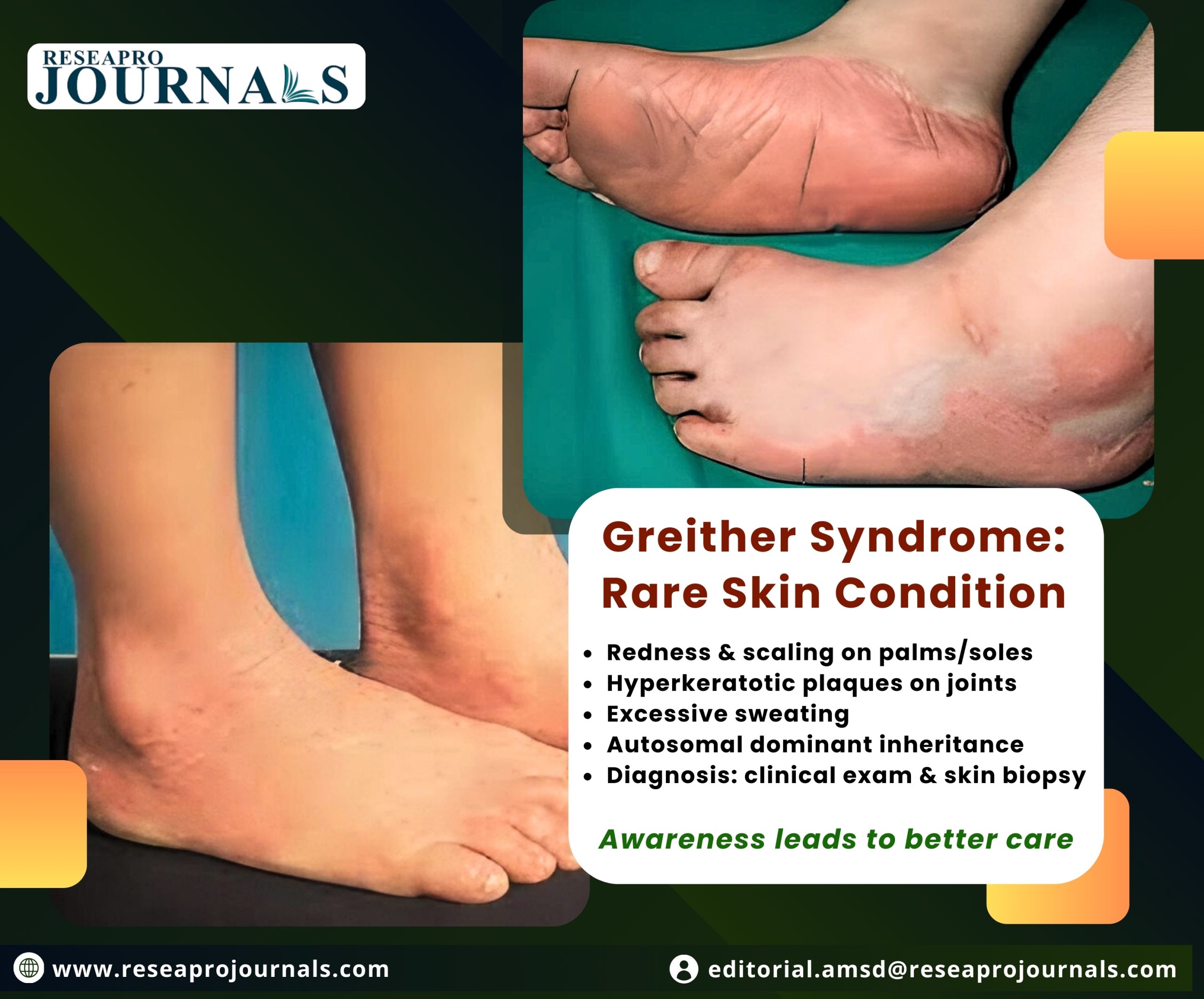 “Greither’s disease: managing thickened skin growths.”